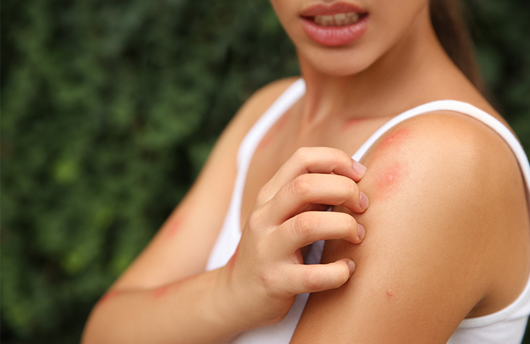 Woman itching mosquito bite on arm
